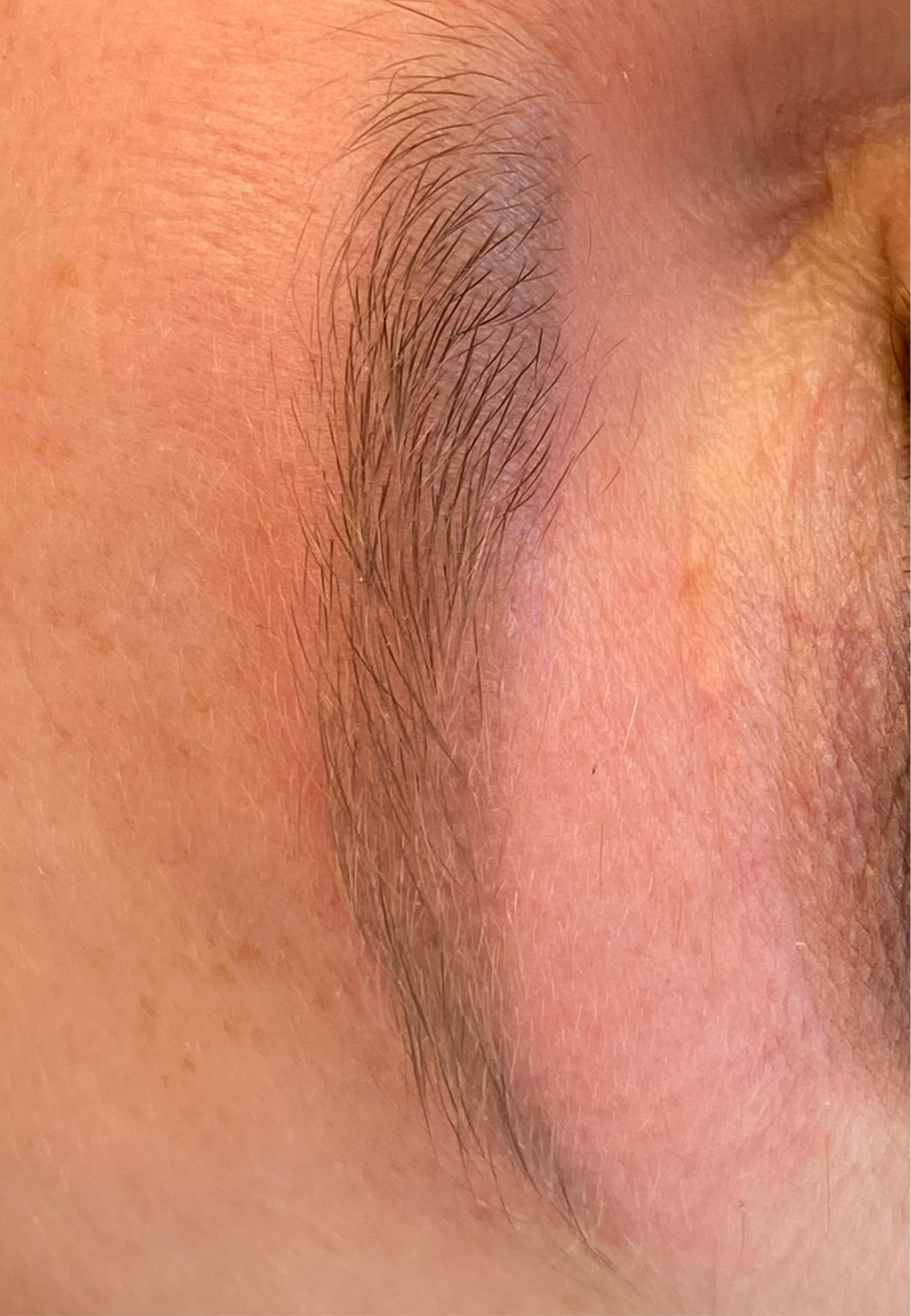 PMU removal met laser voor het veilig en effectief verwijderen van permanente make-up. Geschikt voor wenkbrauwen.