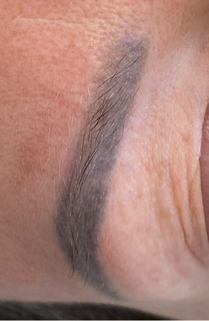 PMU removal met laser voor het veilig en effectief verwijderen van permanente make-up. Geschikt voor wenkbrauwen.