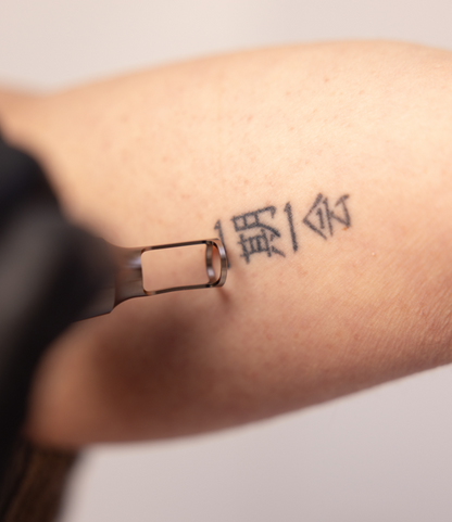 Tatoeage verwijderen met ND Yag laser in Zeist — veilige laserbehandeling bij SAAR